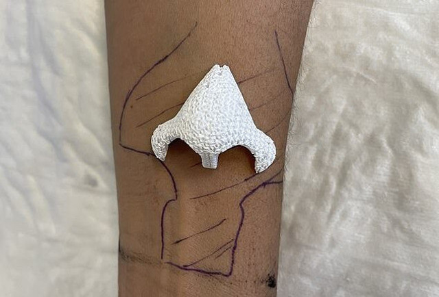 Burnu kolunda yeniden çıktı! Tıp dünyasında çığır açan buluş - Resim: 0