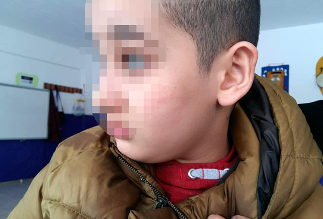 Cani öğretmen! Otizmli çocuğu dövüp morlukları da böyle kapatmış - Resim: 3