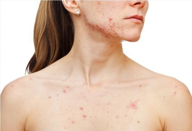 Çenenizde sivilce çıkıyorsa dikkat - Resim: 2