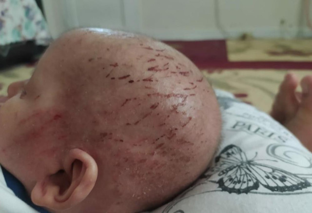 Evde soba yanınca balık kokusu yayan çocuk! Minik Taha'nın eşi benzeri görülmemiş hastalığı - Resim: 0