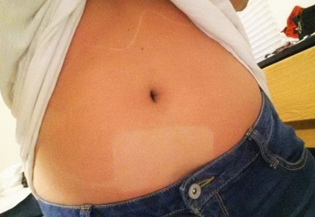 Güneşin acımadığı tatilcilere bakın neler oldu - Resim: 2