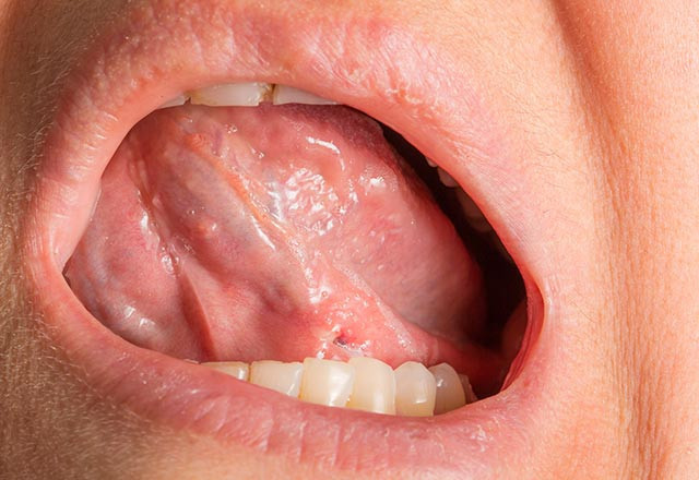 Bu kansere en çok erkekler yakalanıyor - Resim: 4