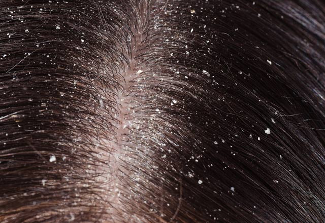 Muz ve avokadoyu karıştırıp kafanıza sürün... İşte kepekten kurtulmanın 5 doğal yolu! - Resim: 1