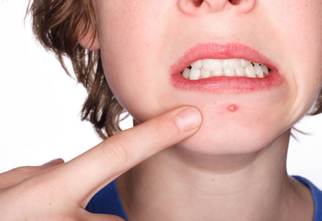 Hep çenenizde sivilce çıkıyorsa dikkat! - Resim: 3