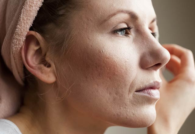 Hep çenenizde sivilce çıkıyorsa dikkat! - Resim: 4