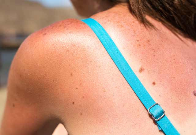 Sırtına tıraş köpüğü sürdü: Acılardan kurtuldu! - Resim: 1