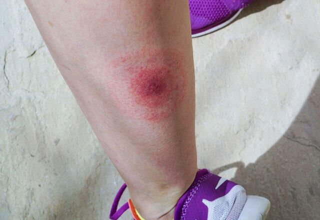 Bu hastalıklar birbiriyle karıştırılıyor yanlış teşhise dikkat! - Resim: 3