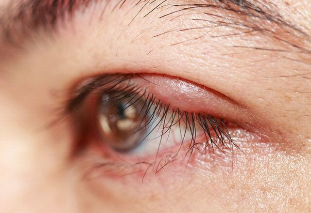 Gözdeki arpacık evde nasıl tedavi edilir? - Resim: 3