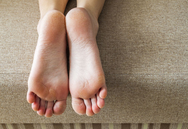Ayak şişliği deyip geçmeyin o hastalığın belirtisi  - Resim: 8