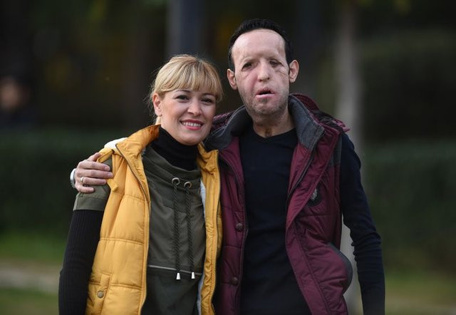 Yüz nakilli Recep Sert tutuklandı! - Resim: 2