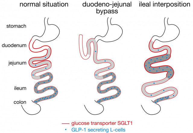 Ömür boyu şeker hastalığından kurtulabilirsiniz! İleal İnterpozisyon ameliyatı - Resim: 0