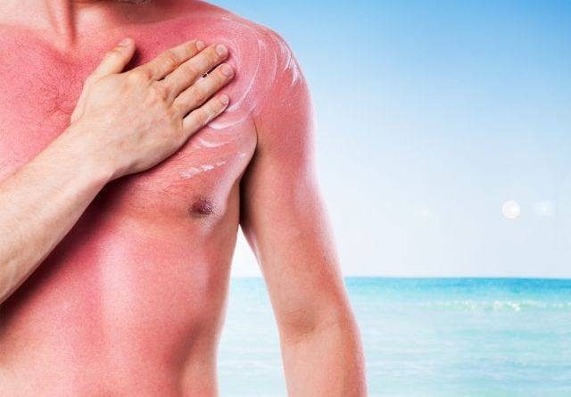 Güneş yanığına ne iyi gelir? Doğru bilinen yanlışlar! - Resim: 1
