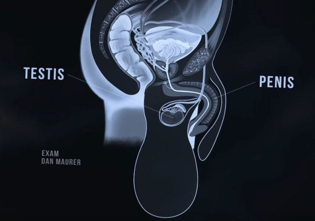 12 yıldır seks yapamayan adamın testisleri 31 kilo oldu! - Resim: 2