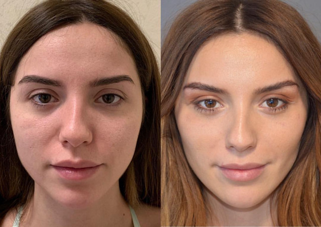 Uzmanından 'Hollywood yanağı' uyarısı - Resim: 1