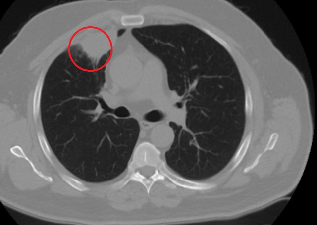 Dünyada ilk kez oldu! Koronavirüs akciğer kanserini taklit etti! - Resim: 1