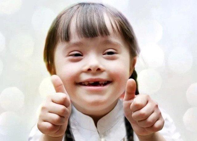 Down Sendromu nedir, belirtiler neler? Down Sendromu ilk kez ne zaman ortaya çıktı? - Resim: 1