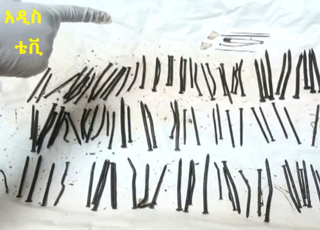 Midesinden çıkan 120 adet çivi şoke etti - Resim: 3