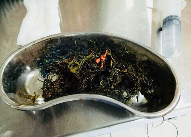 Karın ağrısı nedeniyle hastaneye kaldırıldı içinden bakın ne çıktı - Resim: 2