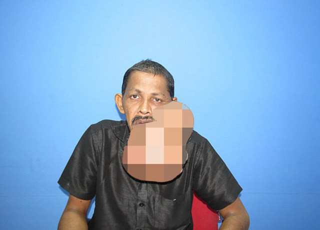 Yüzünden kilolarca tümör alındı! - Resim: 4