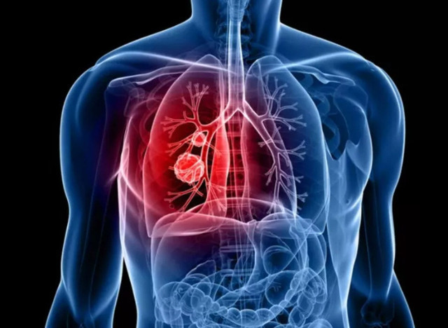 İşte hayatınızı karartacak 8 ölümcül kanser türünün belirtileri - Resim: 0