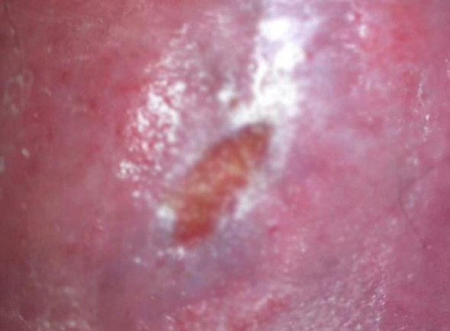 Bacağında tenis topu büyüklüğünde delik açıldı doktora gidince acı gerçeği öğrendi! - Resim: 3