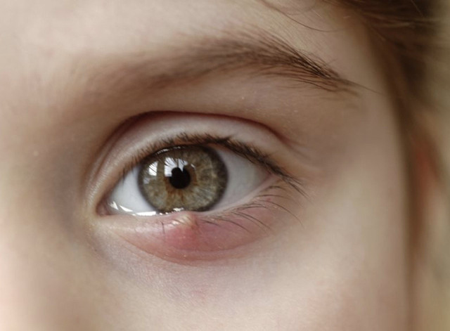 Gözde arpacık neden nasıl geçer evde tedavisi bunlara dikkat edin! - Resim: 1