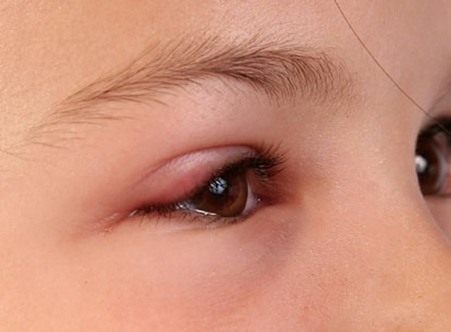 Gözde arpacık neden nasıl geçer evde tedavisi bunlara dikkat edin! - Resim: 0