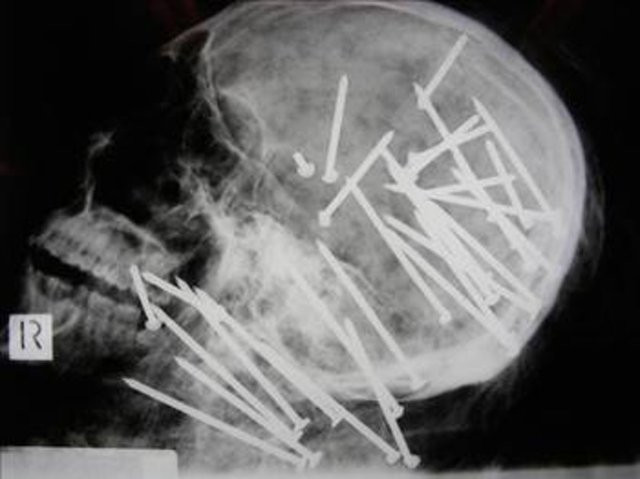 Tıp tarihine geçmiş en korkunç vakalar - Resim: 4