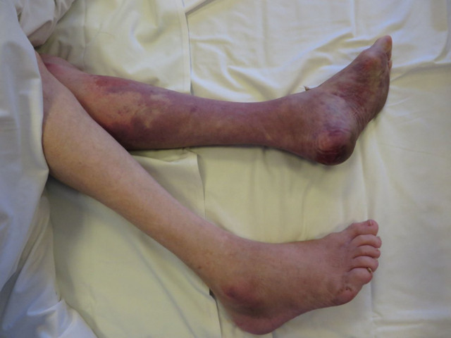 Crush sendromu nedir, belirtileri neler? Crush sendromu tedavisi - Resim: 0