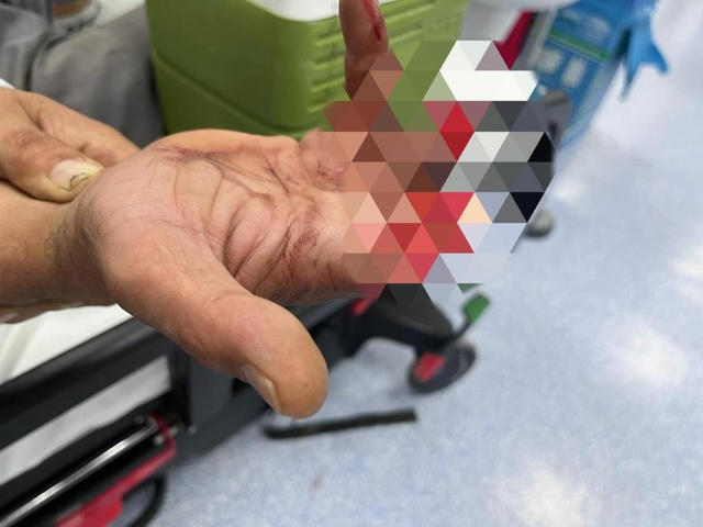 3 parmağını kaybetti ben bittim derken 12 saat sonra parmaklarını buldu - Resim: 1