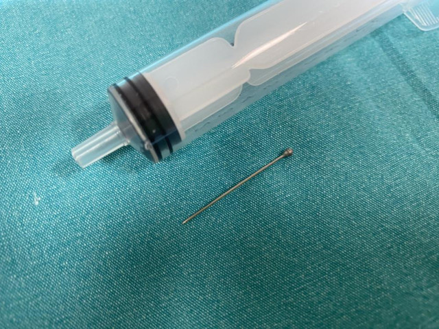 İki çocuk annesi hapşırınca yuttu! Yaklaşık 3,5 santim midesinden çıkarıldı - Resim: 2