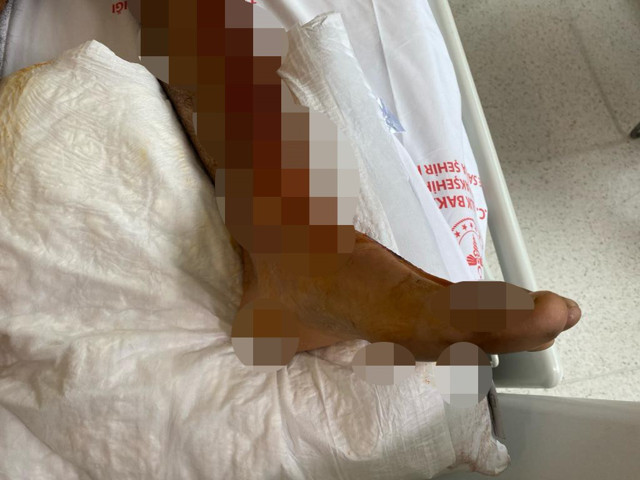 Lavabo açıcı bomba gibi patladı, vücudunun yüzde 35'i yandı - Resim: 2