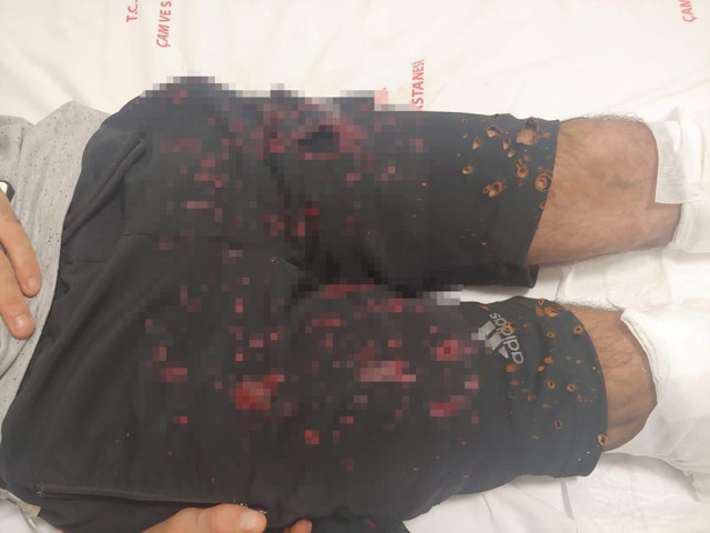 Lavabo açıcı bomba gibi patladı, vücudunun yüzde 35'i yandı - Resim: 0