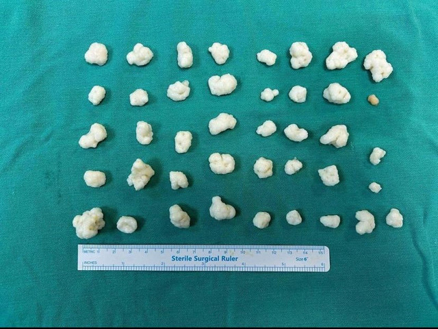 Hastanın dizinden 41 eklem faresi çıktı - Resim: 0