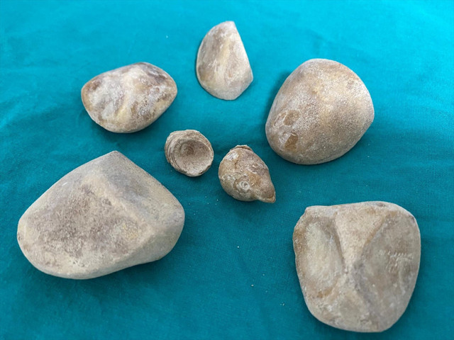 Doktorları bile şaşırttı! 43 yaşındaki kadının idrar kanalı ve mesanesinden 6 taş çıktı - Resim: 0