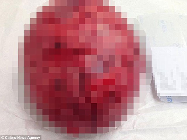 İnanılır gibi değil! 10 yıl boyunca bunu karnında taşımış - Resim: 2