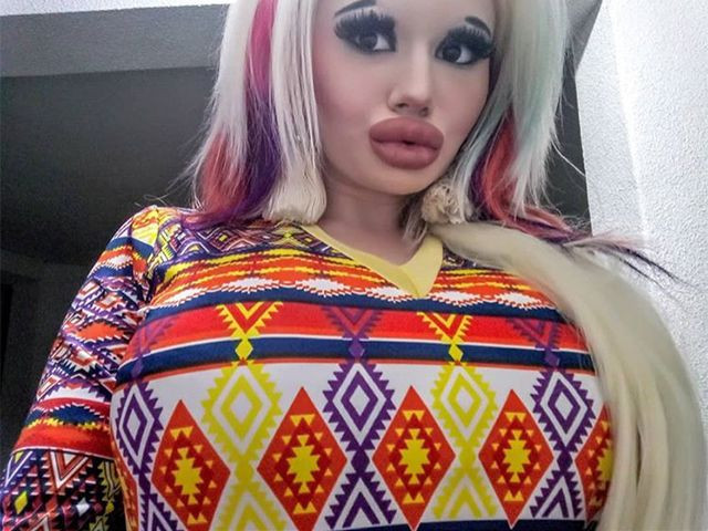 15 ameliyat geçirdi dudakları öyle bir hale geldi ki evlilik teklifi yağıyor - Resim: 1