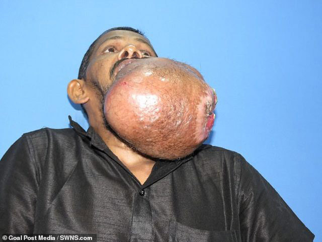 Yüzünden kilolarca tümör alındı! - Resim: 2