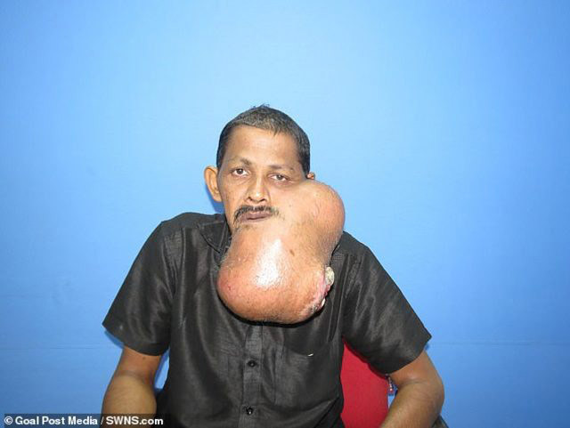 Yüzünden kilolarca tümör alındı! - Resim: 3