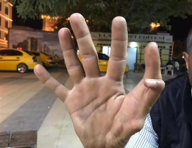 11 parmaklı adam görenleri hayrete düşürüyor: Allah vergisi diye... - Resim: 0