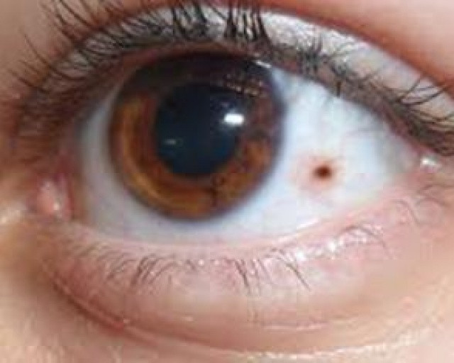 Gözünüzde leke varsa dikkat! - Resim: 4