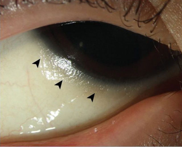 Sadece patates yeyince kör oluyordu - Resim: 1