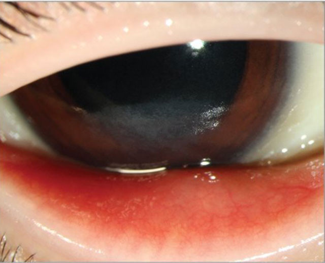 Sadece patates yeyince kör oluyordu - Resim: 3