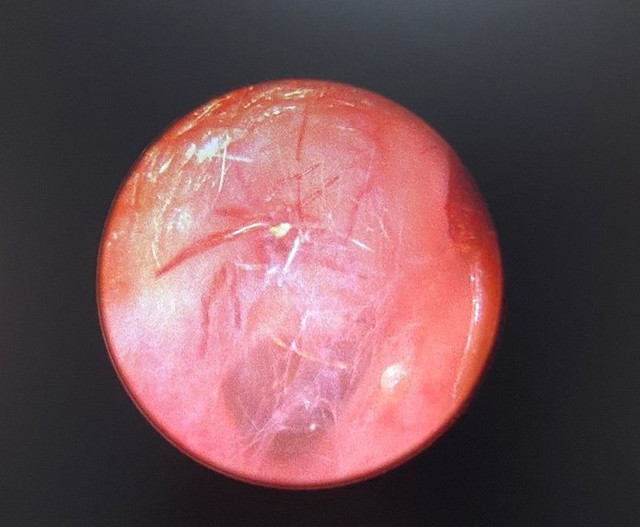 'Hışırtı' şikayetiyle doktora giden kadının kulağından canlı örümcek çıktı - Resim: 0