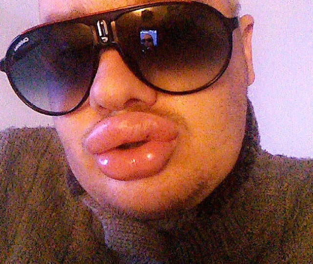 Dudak dolgusu faciası 27 bin lira verdi sonucu şoke etti - Resim: 4