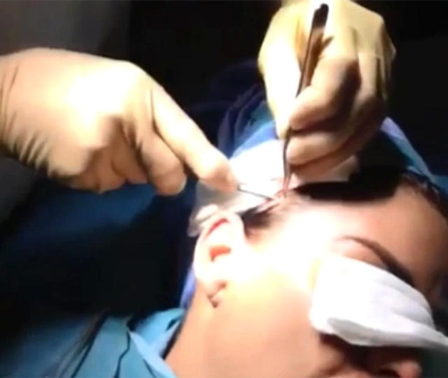 Katie Price yüz germe ameliyatını yayınladı! - Resim: 2