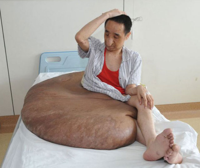 Dünyanın en büyük tümörü onda! - Resim: 2