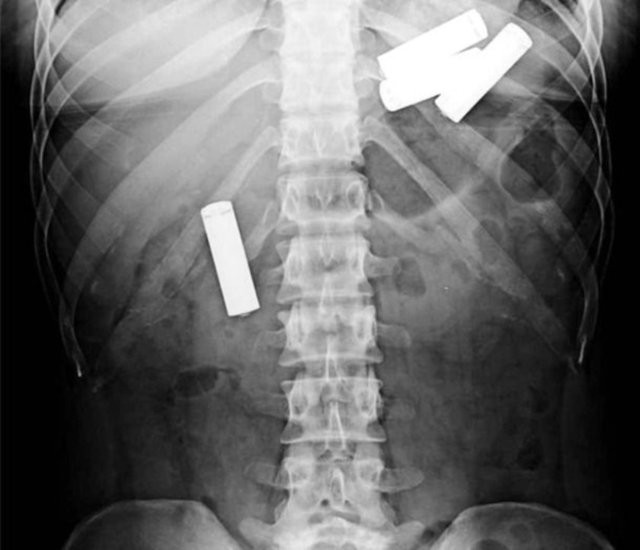 Midesinden öyle şeyler çıktı ki... - Resim: 3