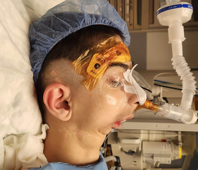 Doğuştan alt çenesi olmayan çocuğa başarılı operasyon: 17 yıl sonra normal yemek yiyebilecek - Resim: 1