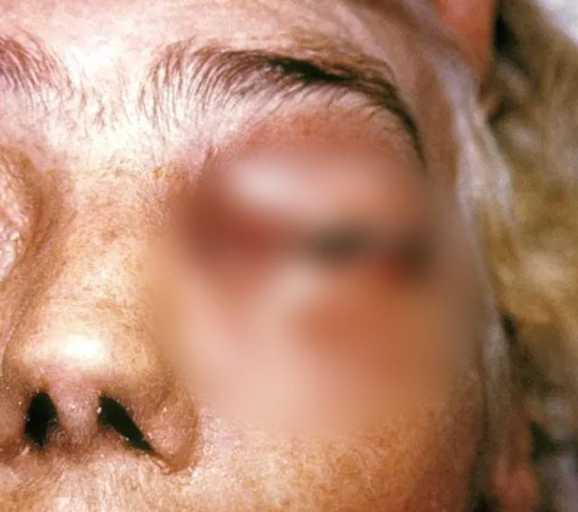 Koronavirüsü atlatanlarda yeni kabus! Gözlerini oyuyorlar yüzde 94 öldürüyor - Resim: 3